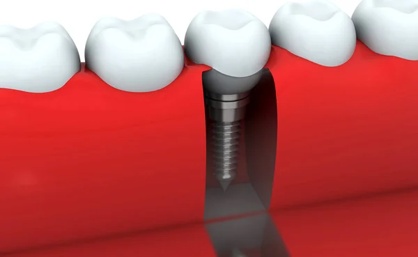 Render Dental Implant Human Tooth — Stock Photo, Image