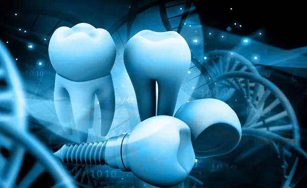 Tooth Human Implant Illustration — Stock Photo, Image