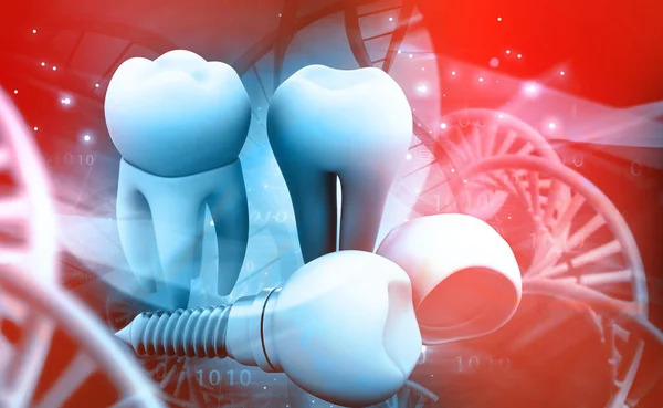 Tooth Human Implant Illustration — Stock Photo, Image