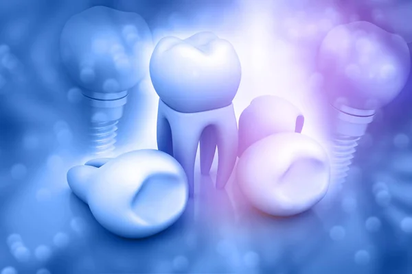 Οδοντικό Εμφύτευμα Απεικόνιση — Φωτογραφία Αρχείου