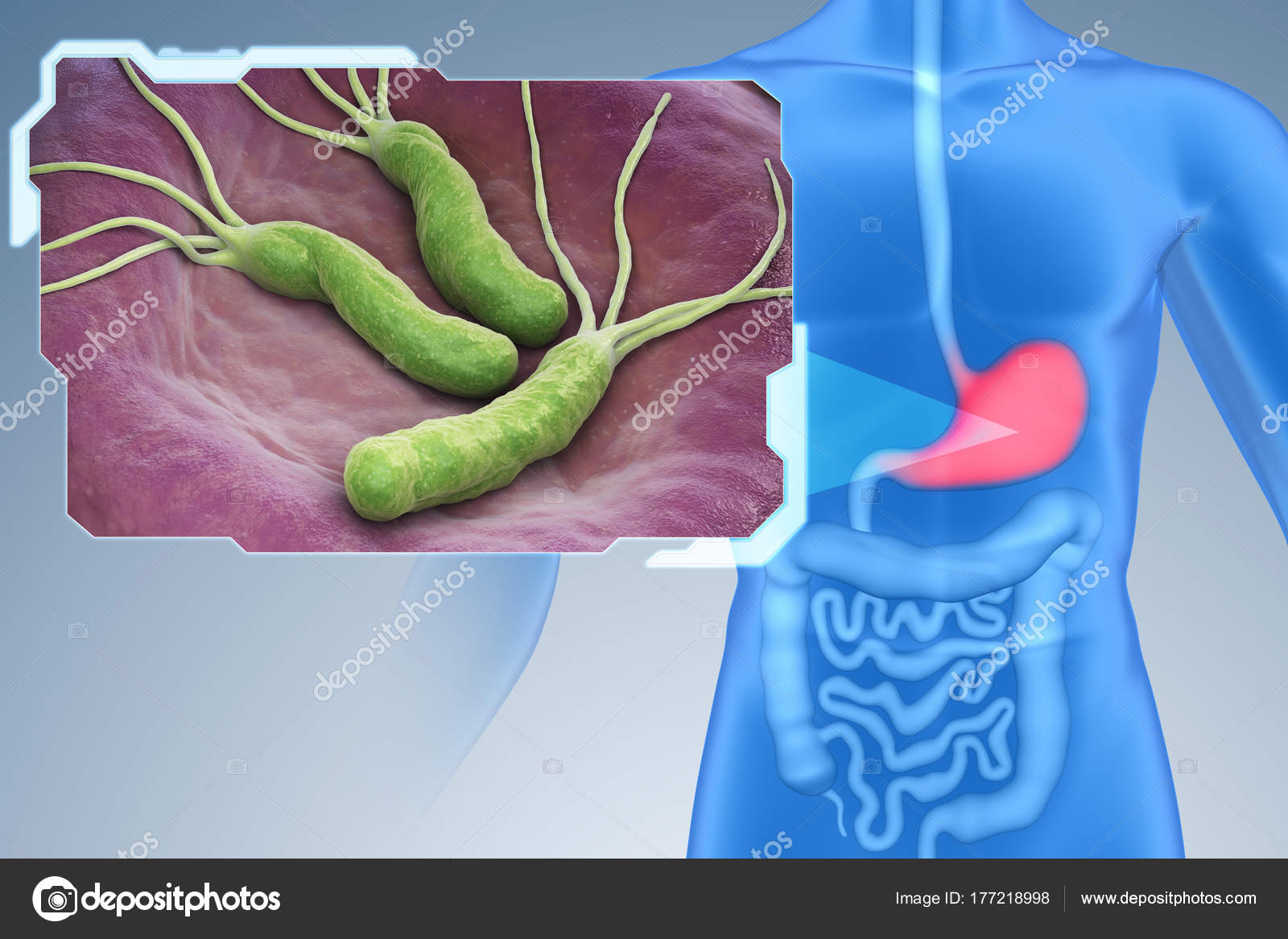 bakterier i magen helicobacter