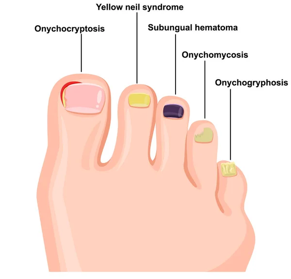 Ilustración de enfermedades de las uñas — Vector de stock