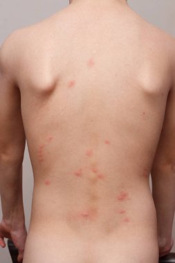 Insect bites of a bedbug such as Cimex lectularius or Cimex hemipterus on the child's body after returning from a vacation tourist trip from another city clipart