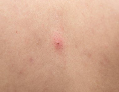 Deride açık kırmızı bir sivilce. Kan kabuğuyla. Yakın plan..