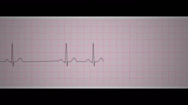 This loop video shows the sinoatrial block tracked on medical paper streep