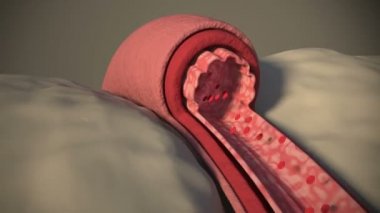This video shows the high blood pressure