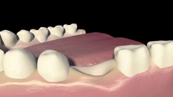 このビデオは歯科ブリッジの手順を示しています — ストック動画