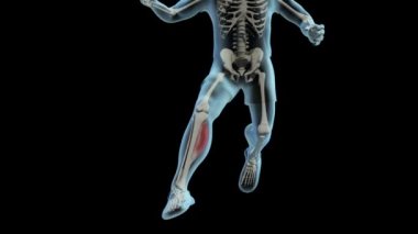 Bu video Achilles Tendon Lezyonunu gösteriyor