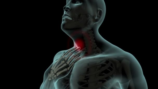 Dieses Video Zeigt Die Halsschmerzen — Stockvideo