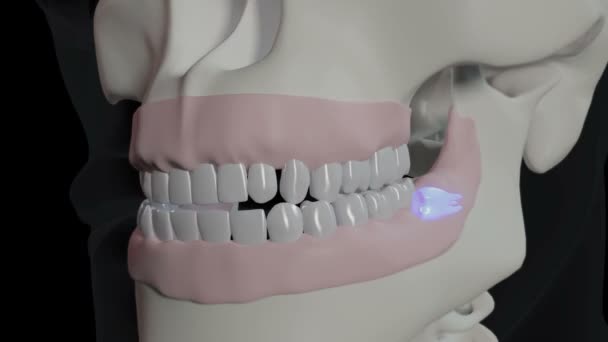 これは影響を受けた知恵の歯です — ストック動画