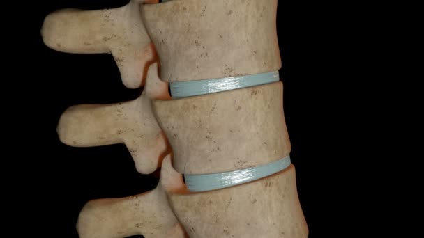 Questo Video Mostra Frattura Compressione Della Vertebra — Video Stock