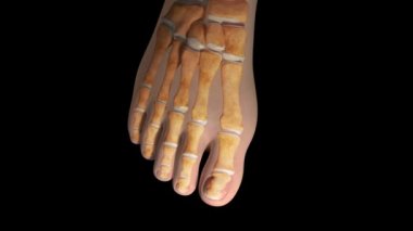 Bu video hallux valgus deformasyonunu gösteriyor.