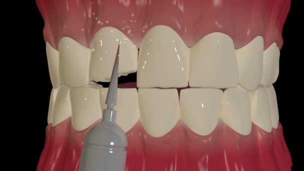 Este Video Muestra Colocación Chapa Dental — Vídeos de Stock