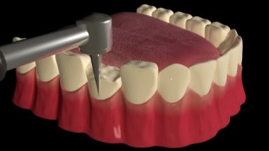 Bu video hasarlı bir dişi korumak için diş kaplaması uygulanma prosedürünü gösteriyor.