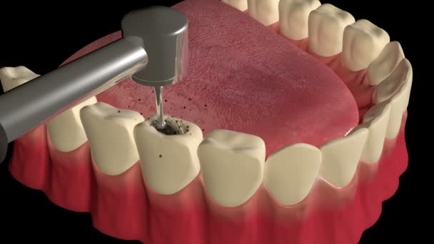 Este Vídeo Mostra Procedimento Enchimento Cavidade Dentária — Vídeo de Stock