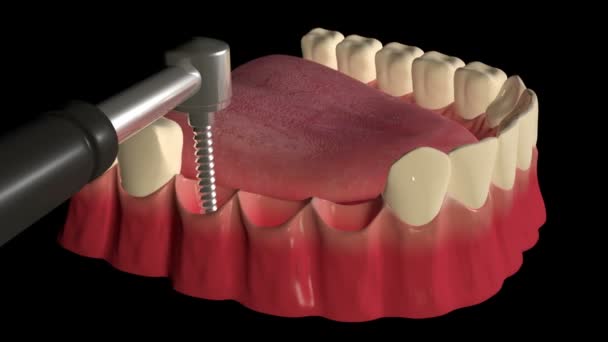 这段视频展示了用种植体支撑的牙桥替换丢失牙齿的程序 — 图库视频影像