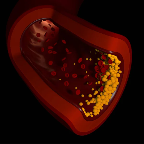 Этой Трехмерной Иллюстрации Показан Сосуд Образованием Холестерола Вид Сверху — стоковое фото