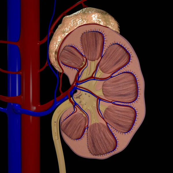 この3Dイラストは腎臓結石の状態を示しています — ストック写真