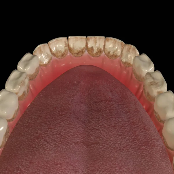 Esta Ilustração Mostra Tártaro Dos Dentes — Fotografia de Stock