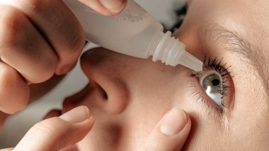 Göz damlası damlayan çekici bir kız, göz kapağının altından göz çuvalı içine damlatıyor, başını geriye atarak yukarı bakıyor. Glukoma, katarakt, göz hastalıkları, alerji, konjonktivit konsepti