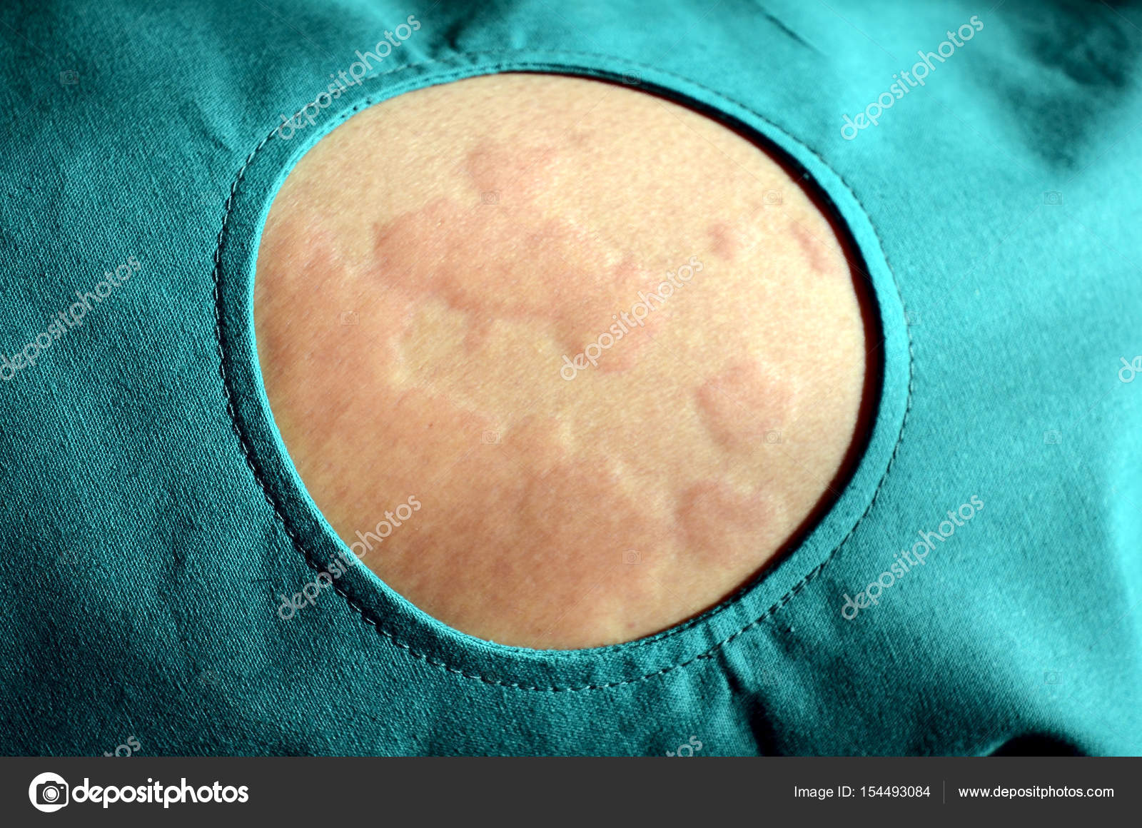 Eruption cutanée, Urticaire, Réaction cutanée allergique . image libre