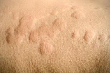 Skin rash, Urticaria, Allergic skin reaction. clipart