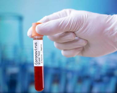 Coronavirus tarafından Covid-19 etiketli biyolojik bir tüp ile kirletilmiş biyolojik bir tüp ve Covid-19 enfeksiyonlu diyabet analizi için laboratuvarda doktor.