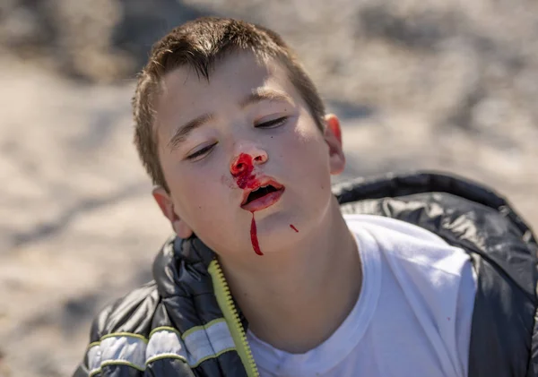 Boy Ten Years Old His Nose Bleeding — Stock Photo, Image