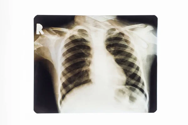 Lung Ray Roentgen Six Year Old Girl Taken Thirty Years — Stock Photo, Image