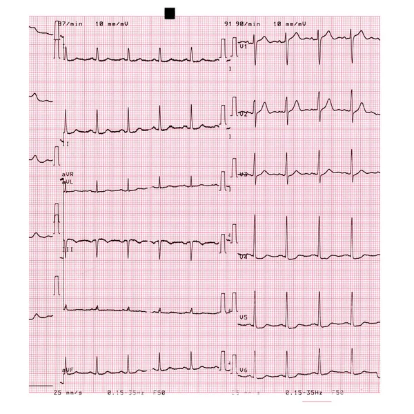 Eletrocardiografia Ecg Aka Ekg Elektrokardiogramm Para Medir Batimento Cardíaco — Fotografia de Stock