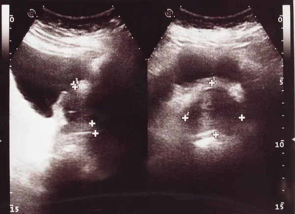 超声诊断与超声诊断成像技术在腹部内体结构可视化中的应用 — 图库照片
