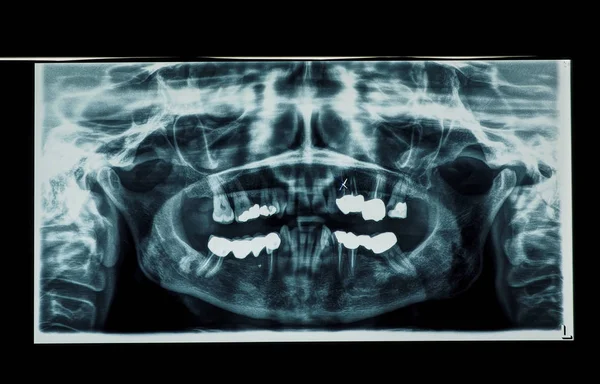 Raio Imagem Diagnóstica Ossos Dentes Humanos — Fotografia de Stock