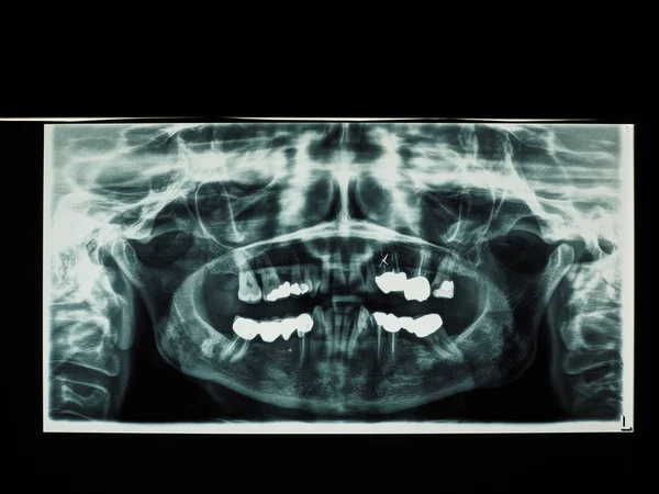 x ray diagnostic image of human teeth bones