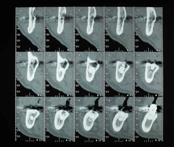 CT scan (aka CAT scan) cross sectional tomographic images x ray of human teeth bones