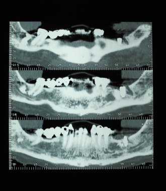 CT taraması (aka Cat taraması) çapraz kesit tomografik görüntüleri röntgen insan diş kemik