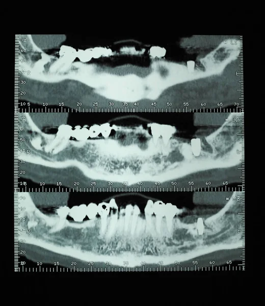 スキャン Cat スキャン別名 十字断面の断層画像人間の歯骨の 線写真 — ストック写真