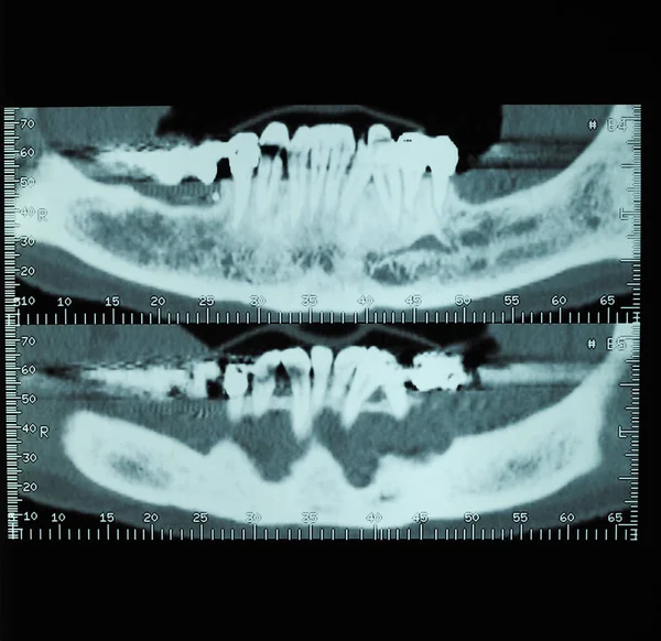 CT scan (aka CAT scan) cross sectional tomographic images x ray of human teeth bones
