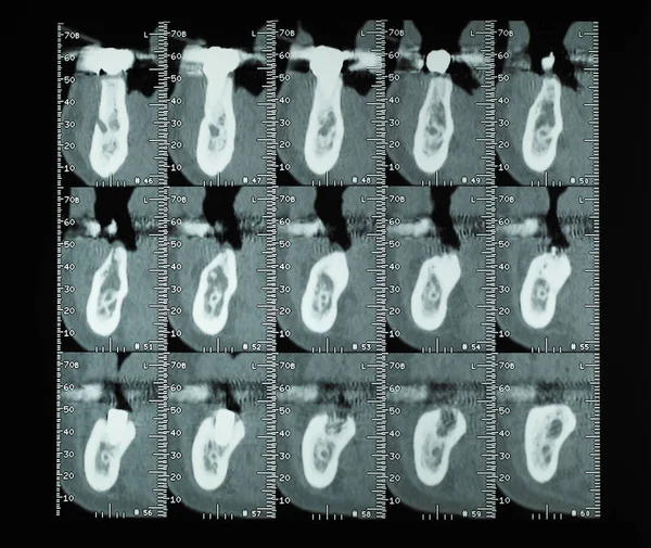 Tomografía Computarizada También Conocida Como Tomografía Computarizada Imágenes Tomográficas Transversales — Foto de Stock