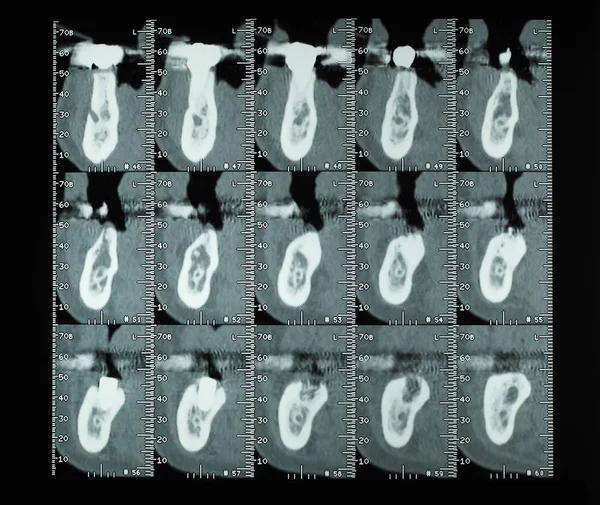 CT scan (aka CAT scan) cross sectional tomographic images x ray of human teeth bones