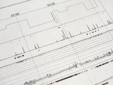Polisomnografi (Psg) uyku çalışması çok parametrik test tanı aracı