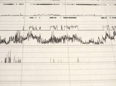 Polisomnografi (Psg) uyku çalışması çok parametrik test tanı aracı
