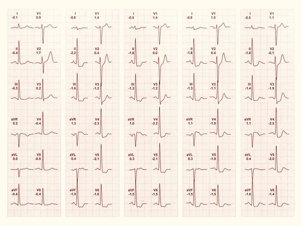 Elektrocardiogram Ecg Aka Ekg Elektrokardiogramm Voor Het Meten Van Hartslag — Stockfoto