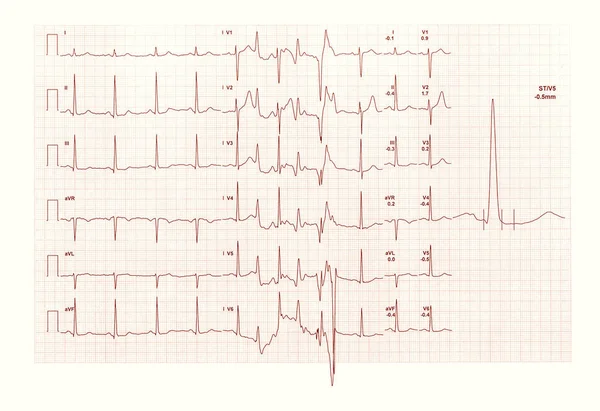 Elettrocardiografia Ecg Aka Ekg Elektrokardiogramm Misurare Battito Cardiaco — Foto Stock