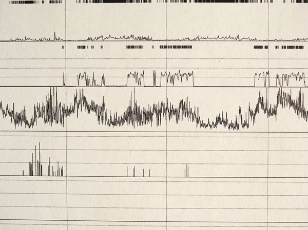 Poliszomnográfia Psg Alvás Tanulmány Multi Paraméteres Teszttel Diagnosztikai Eszköz — Stock Fotó
