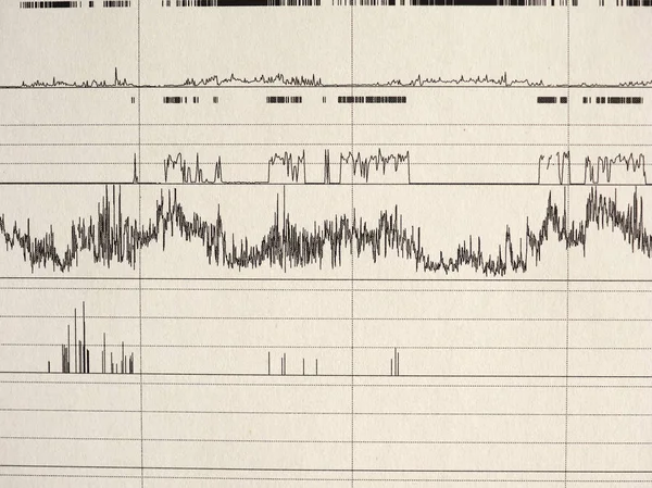 Polysomnography Псж Сну Multi Параметричний Тест Діагностичний Інструмент Вивчення — стокове фото