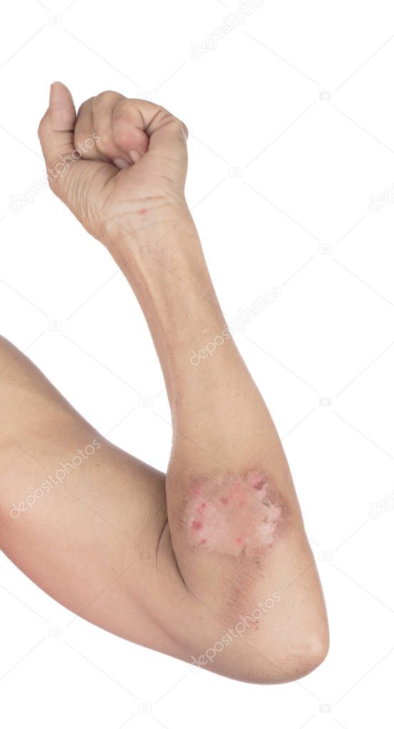 Scalded Skin from Hot Water isolated on a white background