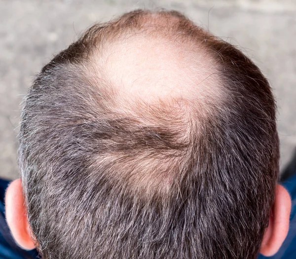 Uomo con i capelli piccoli — Foto Stock