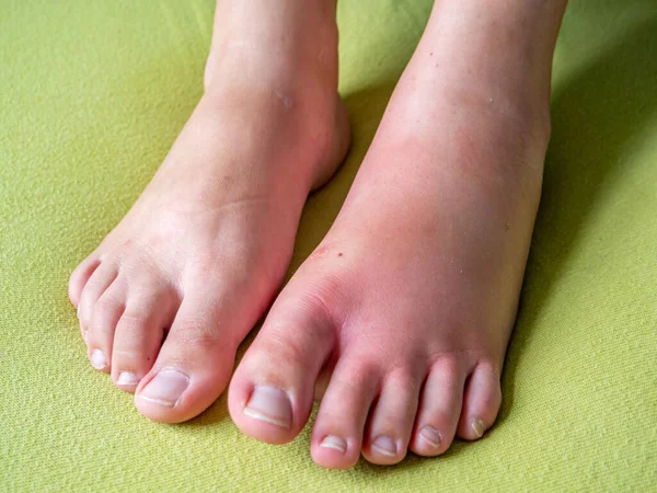 Swollen foot after an insect bite — Stockfoto