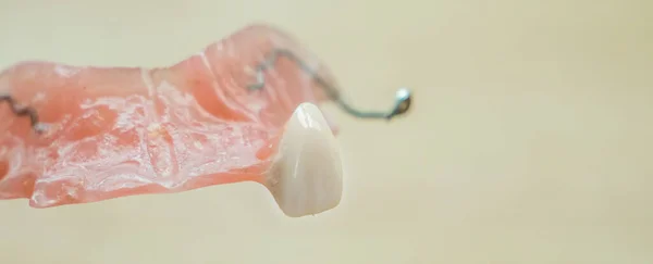 Panorama Tooth prosthesis with one tooth — 스톡 사진