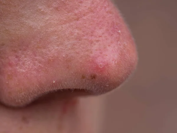 Nez rouge d'une jeune femme — Photo